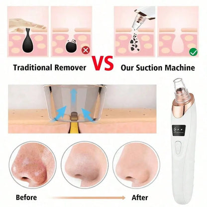5-Level Suction Pore Vacuum Blackhead Remover – Electric Facial Pore Cleanser Kit for Women & Adults